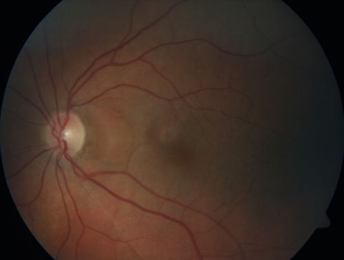 Lupus Choroidopathy - Multifocal PED
82 year old female with spot in her vision for over a year.  PEDs have been stable with VA 20/20 OD; 20/40 OS
