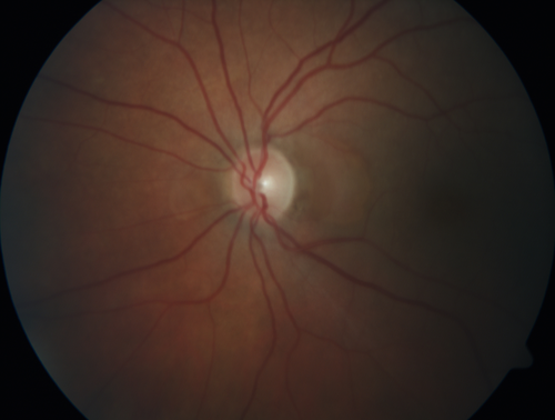 Lupus Choroidopathy - Multifocal PED
82 year old female with spot in her vision for over a year.  PEDs have been stable with VA 20/20 OD; 20/40 OS

