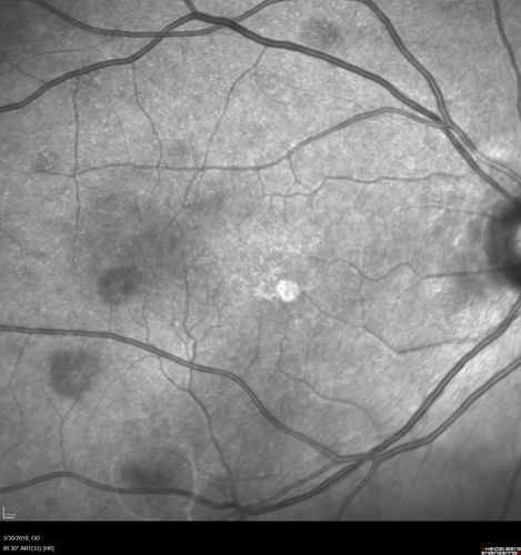 Lupus Choroidopathy - Multifocal PED
82 year old female with spot in her vision for over a year.  PEDs have been stable with VA 20/20 OD; 20/40 OS
