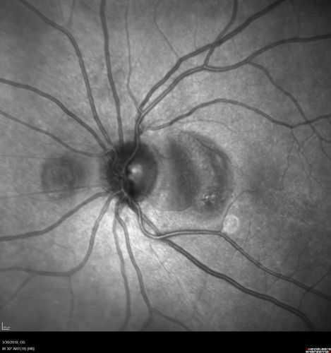 Lupus Choroidopathy - Multifocal PED
82 year old female with spot in her vision for over a year.  PEDs have been stable with VA 20/20 OD; 20/40 OS
