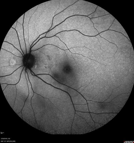 Lupus Choroidopathy - Multifocal PED
82 year old female with spot in her vision for over a year.  PEDs have been stable with VA 20/20 OD; 20/40 OS
