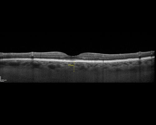 Lupus Choroidopathy - Multifocal PED
82 year old female with spot in her vision for over a year.  PEDs have been stable with VA 20/20 OD; 20/40 OS
