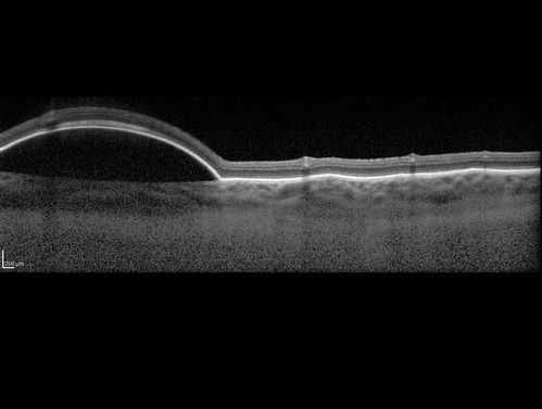 Lupus Choroidopathy - Multifocal PED
82 year old female with spot in her vision for over a year.  PEDs have been stable with VA 20/20 OD; 20/40 OS
