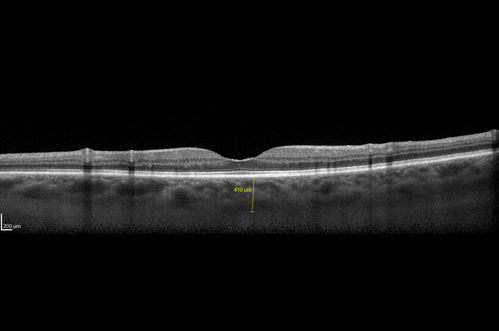 Lupus Choroidopathy - Multifocal PED
82 year old female with spot in her vision for over a year.  PEDs have been stable with VA 20/20 OD; 20/40 OS
