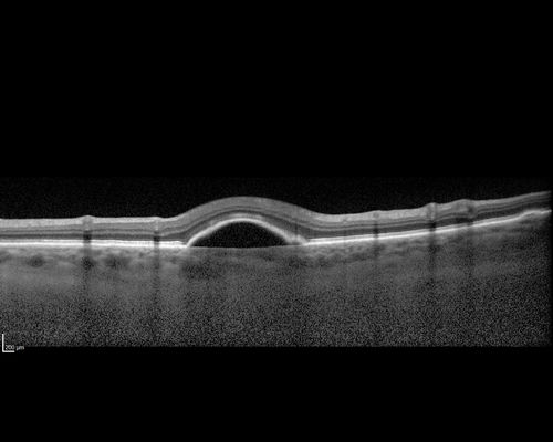 Lupus Choroidopathy - Multifocal PED
82 year old female with spot in her vision for over a year.  PEDs have been stable with VA 20/20 OD; 20/40 OS
