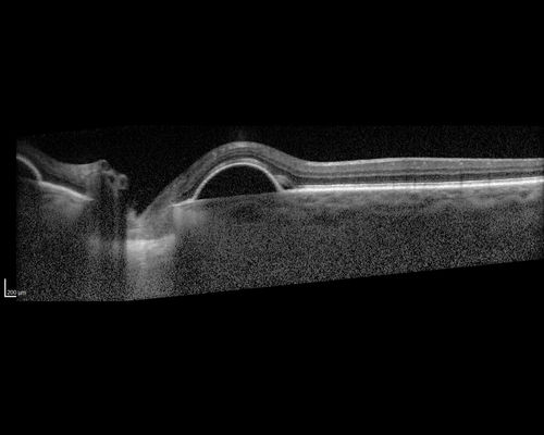 Lupus Choroidopathy - Multifocal PED
82 year old female with spot in her vision for over a year.  PEDs have been stable with VA 20/20 OD; 20/40 OS
