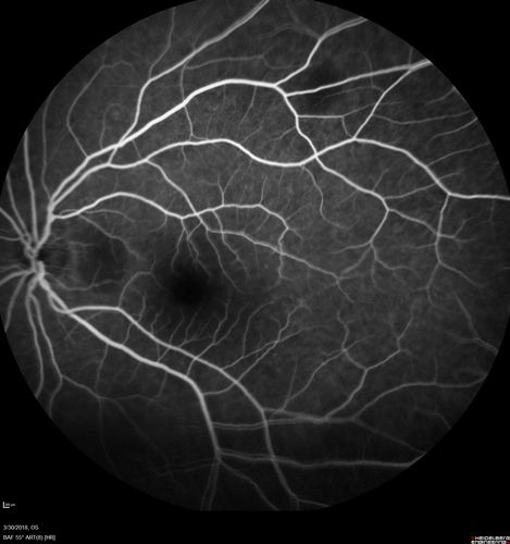 Lupus Choroidopathy - Multifocal PED
82 year old female with spot in her vision for over a year.  PEDs have been stable with VA 20/20 OD; 20/40 OS
