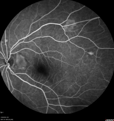Lupus Choroidopathy - Multifocal PED
82 year old female with spot in her vision for over a year.  PEDs have been stable with VA 20/20 OD; 20/40 OS

