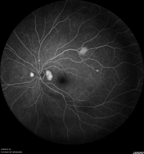 Lupus Choroidopathy - Multifocal PED
82 year old female with spot in her vision for over a year.  PEDs have been stable with VA 20/20 OD; 20/40 OS
