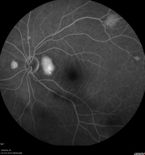 Lupus Choroidopathy - Multifocal PED
82 year old female with spot in her vision for over a year.  PEDs have been stable with VA 20/20 OD; 20/40 OS

