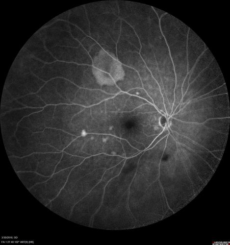 Lupus Choroidopathy - Multifocal PED
82 year old female with spot in her vision for over a year.  PEDs have been stable with VA 20/20 OD; 20/40 OS
