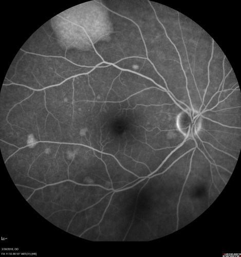 Lupus Choroidopathy - Multifocal PED
82 year old female with spot in her vision for over a year.  PEDs have been stable with VA 20/20 OD; 20/40 OS
