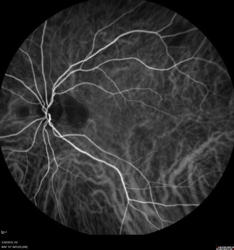Lupus Choroidopathy - Multifocal PED
82 year old female with spot in her vision for over a year.  PEDs have been stable with VA 20/20 OD; 20/40 OS
