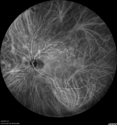 Lupus Choroidopathy - Multifocal PED
82 year old female with spot in her vision for over a year.  PEDs have been stable with VA 20/20 OD; 20/40 OS
