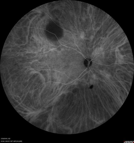Lupus Choroidopathy - Multifocal PED
82 year old female with spot in her vision for over a year.  PEDs have been stable with VA 20/20 OD; 20/40 OS
