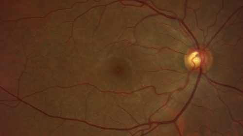 Ocular Lymphoma - Initially presented like auto-immune retinopathy
43 year old man: initial presentation - The vision in the left eye is blurry and opaque for about 2 weeks.Â  In the central of the vision, when he covers the right eye, in the center of the left eye there is a film with a light in the middle.Â  This has never happened before.Â  He has not been sick for the last few months.Â  A few weeks ago he saw waves on the floor when looking down but that has gone away.Â  Since the vision loss started the vision has not changed much.Â  The central vision is not getting better.Â Â 
PMHx â€“ Borderline HTN
VA OD: Dcc20/20
VA OS: Dcc20/40-1 IOP: TP: OD:15 OS:19
1+ NS 
No uveitis
Labs normal.  One positive antiretinal antibody - Arrestin
VA improved over 2 months to normal.  Then the patient had 2 more episodes of self-limited vision loss (no treatment).  Then 2 years later he presented with a diagnosis of CNS lymphoma and later developed subretinal deposits (last images)
