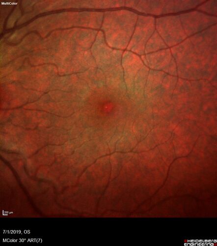 Ocular Lymphoma - Initially presented like auto-immune retinopathy
43 year old man: initial presentation - The vision in the left eye is blurry and opaque for about 2 weeks.Â  In the central of the vision, when he covers the right eye, in the center of the left eye there is a film with a light in the middle.Â  This has never happened before.Â  He has not been sick for the last few months.Â  A few weeks ago he saw waves on the floor when looking down but that has gone away.Â  Since the vision loss started the vision has not changed much.Â  The central vision is not getting better.Â Â 
PMHx â€“ Borderline HTN
VA OD: Dcc20/20
VA OS: Dcc20/40-1 IOP: TP: OD:15 OS:19
1+ NS 
No uveitis
Labs normal.  One positive antiretinal antibody - Arrestin
VA improved over 2 months to normal.  Then the patient had 2 more episodes of self-limited vision loss (no treatment).  Then 2 years later he presented with a diagnosis of CNS lymphoma and later developed subretinal deposits (last images)
