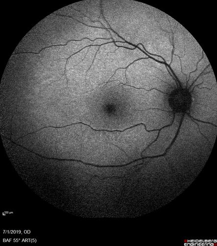 Ocular Lymphoma - Initially presented like auto-immune retinopathy
43 year old man: initial presentation - The vision in the left eye is blurry and opaque for about 2 weeks.Â  In the central of the vision, when he covers the right eye, in the center of the left eye there is a film with a light in the middle.Â  This has never happened before.Â  He has not been sick for the last few months.Â  A few weeks ago he saw waves on the floor when looking down but that has gone away.Â  Since the vision loss started the vision has not changed much.Â  The central vision is not getting better.Â Â 
PMHx â€“ Borderline HTN
VA OD: Dcc20/20
VA OS: Dcc20/40-1 IOP: TP: OD:15 OS:19
1+ NS 
No uveitis
Labs normal.  One positive antiretinal antibody - Arrestin
VA improved over 2 months to normal.  Then the patient had 2 more episodes of self-limited vision loss (no treatment).  Then 2 years later he presented with a diagnosis of CNS lymphoma and later developed subretinal deposits (last images)
