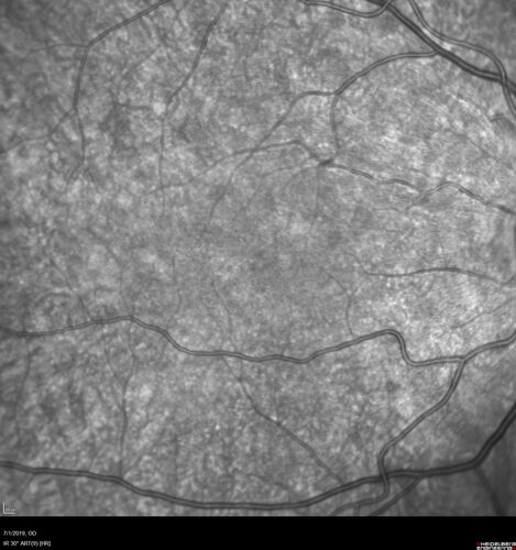 Ocular Lymphoma - Initially presented like auto-immune retinopathy
43 year old man: initial presentation - The vision in the left eye is blurry and opaque for about 2 weeks.Â  In the central of the vision, when he covers the right eye, in the center of the left eye there is a film with a light in the middle.Â  This has never happened before.Â  He has not been sick for the last few months.Â  A few weeks ago he saw waves on the floor when looking down but that has gone away.Â  Since the vision loss started the vision has not changed much.Â  The central vision is not getting better.Â Â 
PMHx â€“ Borderline HTN
VA OD: Dcc20/20
VA OS: Dcc20/40-1 IOP: TP: OD:15 OS:19
1+ NS 
No uveitis
Labs normal.  One positive antiretinal antibody - Arrestin
VA improved over 2 months to normal.  Then the patient had 2 more episodes of self-limited vision loss (no treatment).  Then 2 years later he presented with a diagnosis of CNS lymphoma and later developed subretinal deposits (last images)
