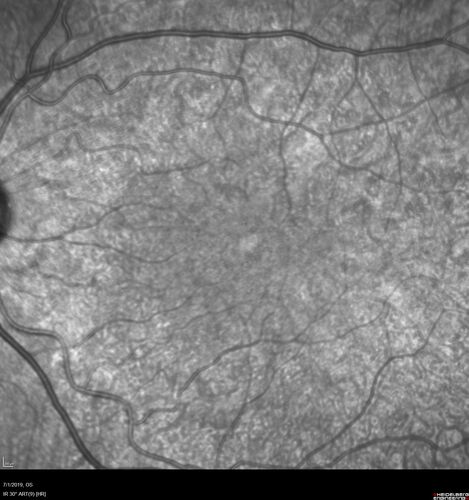 Ocular Lymphoma - Initially presented like auto-immune retinopathy
43 year old man: initial presentation - The vision in the left eye is blurry and opaque for about 2 weeks.Â  In the central of the vision, when he covers the right eye, in the center of the left eye there is a film with a light in the middle.Â  This has never happened before.Â  He has not been sick for the last few months.Â  A few weeks ago he saw waves on the floor when looking down but that has gone away.Â  Since the vision loss started the vision has not changed much.Â  The central vision is not getting better.Â Â 
PMHx â€“ Borderline HTN
VA OD: Dcc20/20
VA OS: Dcc20/40-1 IOP: TP: OD:15 OS:19
1+ NS 
No uveitis
Labs normal.  One positive antiretinal antibody - Arrestin
VA improved over 2 months to normal.  Then the patient had 2 more episodes of self-limited vision loss (no treatment).  Then 2 years later he presented with a diagnosis of CNS lymphoma and later developed subretinal deposits (last images)
