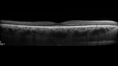 Ocular Lymphoma - Initially presented like auto-immune retinopathy
43 year old man: initial presentation - The vision in the left eye is blurry and opaque for about 2 weeks.Â  In the central of the vision, when he covers the right eye, in the center of the left eye there is a film with a light in the middle.Â  This has never happened before.Â  He has not been sick for the last few months.Â  A few weeks ago he saw waves on the floor when looking down but that has gone away.Â  Since the vision loss started the vision has not changed much.Â  The central vision is not getting better.Â Â 
PMHx â€“ Borderline HTN
VA OD: Dcc20/20
VA OS: Dcc20/40-1 IOP: TP: OD:15 OS:19
1+ NS 
No uveitis
Labs normal.  One positive antiretinal antibody - Arrestin
VA improved over 2 months to normal.  Then the patient had 2 more episodes of self-limited vision loss (no treatment).  Then 2 years later he presented with a diagnosis of CNS lymphoma and later developed subretinal deposits (last images)
