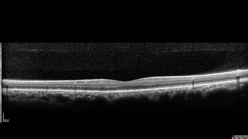 Ocular Lymphoma - Initially presented like auto-immune retinopathy
43 year old man: initial presentation - The vision in the left eye is blurry and opaque for about 2 weeks.Â  In the central of the vision, when he covers the right eye, in the center of the left eye there is a film with a light in the middle.Â  This has never happened before.Â  He has not been sick for the last few months.Â  A few weeks ago he saw waves on the floor when looking down but that has gone away.Â  Since the vision loss started the vision has not changed much.Â  The central vision is not getting better.Â Â 
PMHx â€“ Borderline HTN
VA OD: Dcc20/20
VA OS: Dcc20/40-1 IOP: TP: OD:15 OS:19
1+ NS 
No uveitis
Labs normal.  One positive antiretinal antibody - Arrestin
VA improved over 2 months to normal.  Then the patient had 2 more episodes of self-limited vision loss (no treatment).  Then 2 years later he presented with a diagnosis of CNS lymphoma and later developed subretinal deposits (last images)
