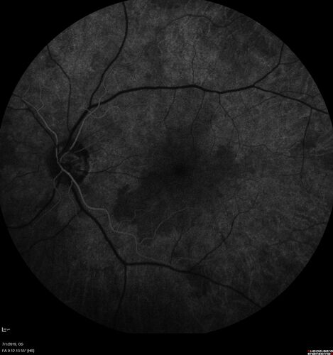 Ocular Lymphoma - Initially presented like auto-immune retinopathy
43 year old man: initial presentation - The vision in the left eye is blurry and opaque for about 2 weeks.Â  In the central of the vision, when he covers the right eye, in the center of the left eye there is a film with a light in the middle.Â  This has never happened before.Â  He has not been sick for the last few months.Â  A few weeks ago he saw waves on the floor when looking down but that has gone away.Â  Since the vision loss started the vision has not changed much.Â  The central vision is not getting better.Â Â 
PMHx â€“ Borderline HTN
VA OD: Dcc20/20
VA OS: Dcc20/40-1 IOP: TP: OD:15 OS:19
1+ NS 
No uveitis
Labs normal.  One positive antiretinal antibody - Arrestin
VA improved over 2 months to normal.  Then the patient had 2 more episodes of self-limited vision loss (no treatment).  Then 2 years later he presented with a diagnosis of CNS lymphoma and later developed subretinal deposits (last images)

