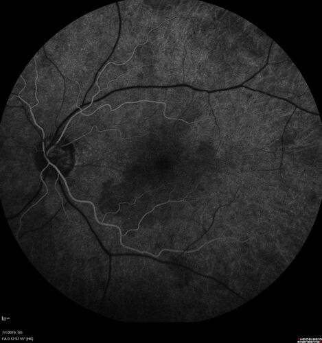 Ocular Lymphoma - Initially presented like auto-immune retinopathy
43 year old man: initial presentation - The vision in the left eye is blurry and opaque for about 2 weeks.Â  In the central of the vision, when he covers the right eye, in the center of the left eye there is a film with a light in the middle.Â  This has never happened before.Â  He has not been sick for the last few months.Â  A few weeks ago he saw waves on the floor when looking down but that has gone away.Â  Since the vision loss started the vision has not changed much.Â  The central vision is not getting better.Â Â 
PMHx â€“ Borderline HTN
VA OD: Dcc20/20
VA OS: Dcc20/40-1 IOP: TP: OD:15 OS:19
1+ NS 
No uveitis
Labs normal.  One positive antiretinal antibody - Arrestin
VA improved over 2 months to normal.  Then the patient had 2 more episodes of self-limited vision loss (no treatment).  Then 2 years later he presented with a diagnosis of CNS lymphoma and later developed subretinal deposits (last images)
