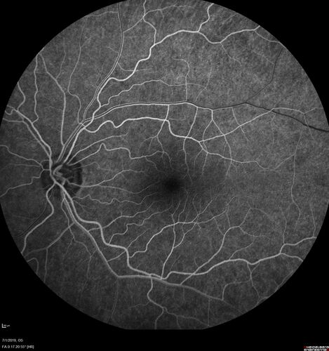 Ocular Lymphoma - Initially presented like auto-immune retinopathy
43 year old man: initial presentation - The vision in the left eye is blurry and opaque for about 2 weeks.Â  In the central of the vision, when he covers the right eye, in the center of the left eye there is a film with a light in the middle.Â  This has never happened before.Â  He has not been sick for the last few months.Â  A few weeks ago he saw waves on the floor when looking down but that has gone away.Â  Since the vision loss started the vision has not changed much.Â  The central vision is not getting better.Â Â 
PMHx â€“ Borderline HTN
VA OD: Dcc20/20
VA OS: Dcc20/40-1 IOP: TP: OD:15 OS:19
1+ NS 
No uveitis
Labs normal.  One positive antiretinal antibody - Arrestin
VA improved over 2 months to normal.  Then the patient had 2 more episodes of self-limited vision loss (no treatment).  Then 2 years later he presented with a diagnosis of CNS lymphoma and later developed subretinal deposits (last images)
