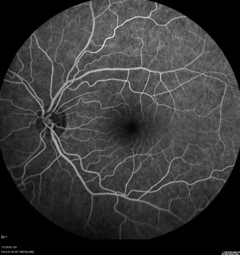 Ocular Lymphoma - Initially presented like auto-immune retinopathy
43 year old man: initial presentation - The vision in the left eye is blurry and opaque for about 2 weeks.Â  In the central of the vision, when he covers the right eye, in the center of the left eye there is a film with a light in the middle.Â  This has never happened before.Â  He has not been sick for the last few months.Â  A few weeks ago he saw waves on the floor when looking down but that has gone away.Â  Since the vision loss started the vision has not changed much.Â  The central vision is not getting better.Â Â 
PMHx â€“ Borderline HTN
VA OD: Dcc20/20
VA OS: Dcc20/40-1 IOP: TP: OD:15 OS:19
1+ NS 
No uveitis
Labs normal.  One positive antiretinal antibody - Arrestin
VA improved over 2 months to normal.  Then the patient had 2 more episodes of self-limited vision loss (no treatment).  Then 2 years later he presented with a diagnosis of CNS lymphoma and later developed subretinal deposits (last images)
