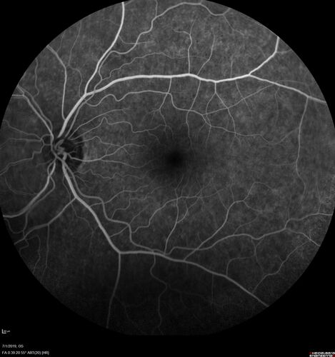 Ocular Lymphoma - Initially presented like auto-immune retinopathy
43 year old man: initial presentation - The vision in the left eye is blurry and opaque for about 2 weeks.Â  In the central of the vision, when he covers the right eye, in the center of the left eye there is a film with a light in the middle.Â  This has never happened before.Â  He has not been sick for the last few months.Â  A few weeks ago he saw waves on the floor when looking down but that has gone away.Â  Since the vision loss started the vision has not changed much.Â  The central vision is not getting better.Â Â 
PMHx â€“ Borderline HTN
VA OD: Dcc20/20
VA OS: Dcc20/40-1 IOP: TP: OD:15 OS:19
1+ NS 
No uveitis
Labs normal.  One positive antiretinal antibody - Arrestin
VA improved over 2 months to normal.  Then the patient had 2 more episodes of self-limited vision loss (no treatment).  Then 2 years later he presented with a diagnosis of CNS lymphoma and later developed subretinal deposits (last images)
