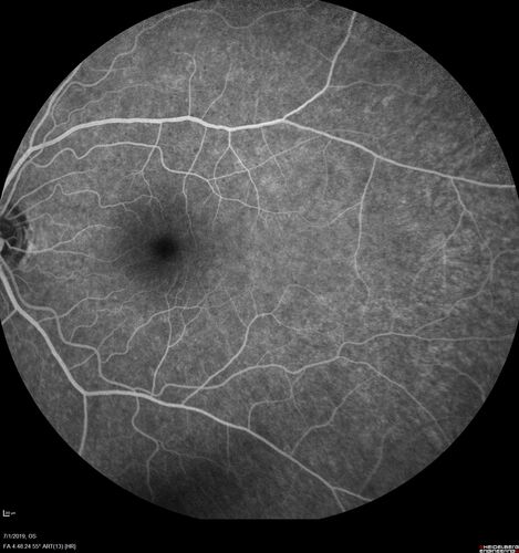 Ocular Lymphoma - Initially presented like auto-immune retinopathy
43 year old man: initial presentation - The vision in the left eye is blurry and opaque for about 2 weeks.Â  In the central of the vision, when he covers the right eye, in the center of the left eye there is a film with a light in the middle.Â  This has never happened before.Â  He has not been sick for the last few months.Â  A few weeks ago he saw waves on the floor when looking down but that has gone away.Â  Since the vision loss started the vision has not changed much.Â  The central vision is not getting better.Â Â 
PMHx â€“ Borderline HTN
VA OD: Dcc20/20
VA OS: Dcc20/40-1 IOP: TP: OD:15 OS:19
1+ NS 
No uveitis
Labs normal.  One positive antiretinal antibody - Arrestin
VA improved over 2 months to normal.  Then the patient had 2 more episodes of self-limited vision loss (no treatment).  Then 2 years later he presented with a diagnosis of CNS lymphoma and later developed subretinal deposits (last images)
