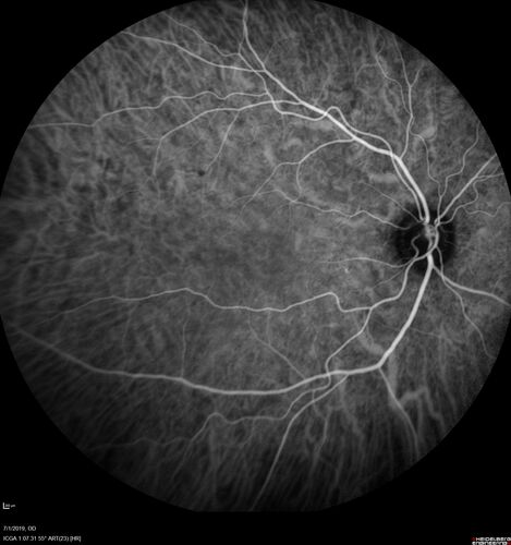 Ocular Lymphoma - Initially presented like auto-immune retinopathy
43 year old man: initial presentation - The vision in the left eye is blurry and opaque for about 2 weeks.Â  In the central of the vision, when he covers the right eye, in the center of the left eye there is a film with a light in the middle.Â  This has never happened before.Â  He has not been sick for the last few months.Â  A few weeks ago he saw waves on the floor when looking down but that has gone away.Â  Since the vision loss started the vision has not changed much.Â  The central vision is not getting better.Â Â 
PMHx â€“ Borderline HTN
VA OD: Dcc20/20
VA OS: Dcc20/40-1 IOP: TP: OD:15 OS:19
1+ NS 
No uveitis
Labs normal.  One positive antiretinal antibody - Arrestin
VA improved over 2 months to normal.  Then the patient had 2 more episodes of self-limited vision loss (no treatment).  Then 2 years later he presented with a diagnosis of CNS lymphoma and later developed subretinal deposits (last images)

