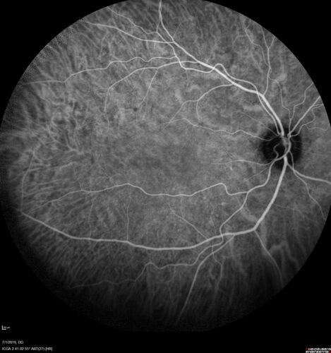 Ocular Lymphoma - Initially presented like auto-immune retinopathy
43 year old man: initial presentation - The vision in the left eye is blurry and opaque for about 2 weeks.Â  In the central of the vision, when he covers the right eye, in the center of the left eye there is a film with a light in the middle.Â  This has never happened before.Â  He has not been sick for the last few months.Â  A few weeks ago he saw waves on the floor when looking down but that has gone away.Â  Since the vision loss started the vision has not changed much.Â  The central vision is not getting better.Â Â 
PMHx â€“ Borderline HTN
VA OD: Dcc20/20
VA OS: Dcc20/40-1 IOP: TP: OD:15 OS:19
1+ NS 
No uveitis
Labs normal.  One positive antiretinal antibody - Arrestin
VA improved over 2 months to normal.  Then the patient had 2 more episodes of self-limited vision loss (no treatment).  Then 2 years later he presented with a diagnosis of CNS lymphoma and later developed subretinal deposits (last images)
