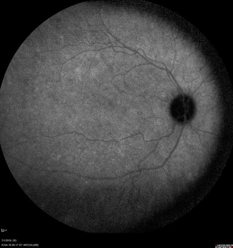 Ocular Lymphoma - Initially presented like auto-immune retinopathy
43 year old man: initial presentation - The vision in the left eye is blurry and opaque for about 2 weeks.Â  In the central of the vision, when he covers the right eye, in the center of the left eye there is a film with a light in the middle.Â  This has never happened before.Â  He has not been sick for the last few months.Â  A few weeks ago he saw waves on the floor when looking down but that has gone away.Â  Since the vision loss started the vision has not changed much.Â  The central vision is not getting better.Â Â 
PMHx â€“ Borderline HTN
VA OD: Dcc20/20
VA OS: Dcc20/40-1 IOP: TP: OD:15 OS:19
1+ NS 
No uveitis
Labs normal.  One positive antiretinal antibody - Arrestin
VA improved over 2 months to normal.  Then the patient had 2 more episodes of self-limited vision loss (no treatment).  Then 2 years later he presented with a diagnosis of CNS lymphoma and later developed subretinal deposits (last images)
