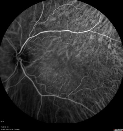 Ocular Lymphoma - Initially presented like auto-immune retinopathy
43 year old man: initial presentation - The vision in the left eye is blurry and opaque for about 2 weeks.Â  In the central of the vision, when he covers the right eye, in the center of the left eye there is a film with a light in the middle.Â  This has never happened before.Â  He has not been sick for the last few months.Â  A few weeks ago he saw waves on the floor when looking down but that has gone away.Â  Since the vision loss started the vision has not changed much.Â  The central vision is not getting better.Â Â 
PMHx â€“ Borderline HTN
VA OD: Dcc20/20
VA OS: Dcc20/40-1 IOP: TP: OD:15 OS:19
1+ NS 
No uveitis
Labs normal.  One positive antiretinal antibody - Arrestin
VA improved over 2 months to normal.  Then the patient had 2 more episodes of self-limited vision loss (no treatment).  Then 2 years later he presented with a diagnosis of CNS lymphoma and later developed subretinal deposits (last images)
