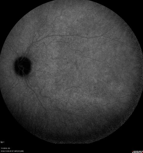 Ocular Lymphoma - Initially presented like auto-immune retinopathy
43 year old man: initial presentation - The vision in the left eye is blurry and opaque for about 2 weeks.Â  In the central of the vision, when he covers the right eye, in the center of the left eye there is a film with a light in the middle.Â  This has never happened before.Â  He has not been sick for the last few months.Â  A few weeks ago he saw waves on the floor when looking down but that has gone away.Â  Since the vision loss started the vision has not changed much.Â  The central vision is not getting better.Â Â 
PMHx â€“ Borderline HTN
VA OD: Dcc20/20
VA OS: Dcc20/40-1 IOP: TP: OD:15 OS:19
1+ NS 
No uveitis
Labs normal.  One positive antiretinal antibody - Arrestin
VA improved over 2 months to normal.  Then the patient had 2 more episodes of self-limited vision loss (no treatment).  Then 2 years later he presented with a diagnosis of CNS lymphoma and later developed subretinal deposits (last images)
