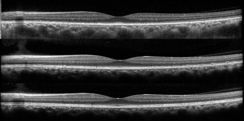 Ocular Lymphoma - Initially presented like auto-immune retinopathy
43 year old man: initial presentation - The vision in the left eye is blurry and opaque for about 2 weeks.Â  In the central of the vision, when he covers the right eye, in the center of the left eye there is a film with a light in the middle.Â  This has never happened before.Â  He has not been sick for the last few months.Â  A few weeks ago he saw waves on the floor when looking down but that has gone away.Â  Since the vision loss started the vision has not changed much.Â  The central vision is not getting better.Â Â 
PMHx â€“ Borderline HTN
VA OD: Dcc20/20
VA OS: Dcc20/40-1 IOP: TP: OD:15 OS:19
1+ NS 
No uveitis
Labs normal.  One positive antiretinal antibody - Arrestin
VA improved over 2 months to normal.  Then the patient had 2 more episodes of self-limited vision loss (no treatment).  Then 2 years later he presented with a diagnosis of CNS lymphoma and later developed subretinal deposits (last images)
