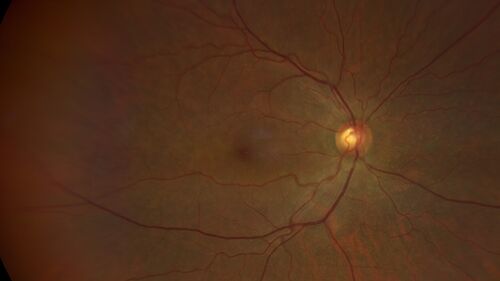 Ocular Lymphoma - Initially presented like auto-immune retinopathy
43 year old man: initial presentation - The vision in the left eye is blurry and opaque for about 2 weeks.Â  In the central of the vision, when he covers the right eye, in the center of the left eye there is a film with a light in the middle.Â  This has never happened before.Â  He has not been sick for the last few months.Â  A few weeks ago he saw waves on the floor when looking down but that has gone away.Â  Since the vision loss started the vision has not changed much.Â  The central vision is not getting better.Â Â 
PMHx â€“ Borderline HTN
VA OD: Dcc20/20
VA OS: Dcc20/40-1 IOP: TP: OD:15 OS:19
1+ NS 
No uveitis
Labs normal.  One positive antiretinal antibody - Arrestin
VA improved over 2 months to normal.  Then the patient had 2 more episodes of self-limited vision loss (no treatment).  Then 2 years later he presented with a diagnosis of CNS lymphoma and later developed subretinal deposits (last images)
