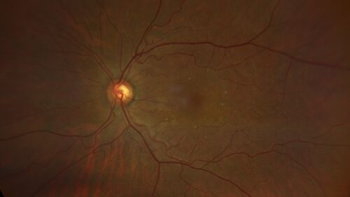 Ocular Lymphoma - Initially presented like auto-immune retinopathy
43 year old man: initial presentation - The vision in the left eye is blurry and opaque for about 2 weeks.Â  In the central of the vision, when he covers the right eye, in the center of the left eye there is a film with a light in the middle.Â  This has never happened before.Â  He has not been sick for the last few months.Â  A few weeks ago he saw waves on the floor when looking down but that has gone away.Â  Since the vision loss started the vision has not changed much.Â  The central vision is not getting better.Â Â 
PMHx â€“ Borderline HTN
VA OD: Dcc20/20
VA OS: Dcc20/40-1 IOP: TP: OD:15 OS:19
1+ NS 
No uveitis
Labs normal.  One positive antiretinal antibody - Arrestin
VA improved over 2 months to normal.  Then the patient had 2 more episodes of self-limited vision loss (no treatment).  Then 2 years later he presented with a diagnosis of CNS lymphoma and later developed subretinal deposits (last images)
