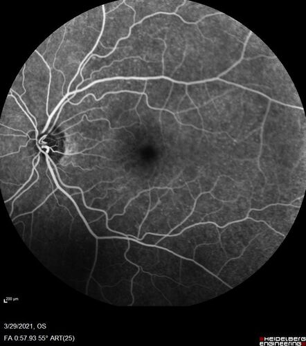 Ocular Lymphoma - Initially presented like auto-immune retinopathy
43 year old man: initial presentation - The vision in the left eye is blurry and opaque for about 2 weeks.Â  In the central of the vision, when he covers the right eye, in the center of the left eye there is a film with a light in the middle.Â  This has never happened before.Â  He has not been sick for the last few months.Â  A few weeks ago he saw waves on the floor when looking down but that has gone away.Â  Since the vision loss started the vision has not changed much.Â  The central vision is not getting better.Â Â 
PMHx â€“ Borderline HTN
VA OD: Dcc20/20
VA OS: Dcc20/40-1 IOP: TP: OD:15 OS:19
1+ NS 
No uveitis
Labs normal.  One positive antiretinal antibody - Arrestin
VA improved over 2 months to normal.  Then the patient had 2 more episodes of self-limited vision loss (no treatment).  Then 2 years later he presented with a diagnosis of CNS lymphoma and later developed subretinal deposits (last images)
