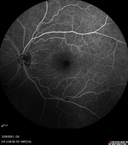 Ocular Lymphoma - Initially presented like auto-immune retinopathy
43 year old man: initial presentation - The vision in the left eye is blurry and opaque for about 2 weeks.Â  In the central of the vision, when he covers the right eye, in the center of the left eye there is a film with a light in the middle.Â  This has never happened before.Â  He has not been sick for the last few months.Â  A few weeks ago he saw waves on the floor when looking down but that has gone away.Â  Since the vision loss started the vision has not changed much.Â  The central vision is not getting better.Â Â 
PMHx â€“ Borderline HTN
VA OD: Dcc20/20
VA OS: Dcc20/40-1 IOP: TP: OD:15 OS:19
1+ NS 
No uveitis
Labs normal.  One positive antiretinal antibody - Arrestin
VA improved over 2 months to normal.  Then the patient had 2 more episodes of self-limited vision loss (no treatment).  Then 2 years later he presented with a diagnosis of CNS lymphoma and later developed subretinal deposits (last images)
