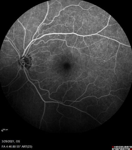 Ocular Lymphoma - Initially presented like auto-immune retinopathy
43 year old man: initial presentation - The vision in the left eye is blurry and opaque for about 2 weeks.Â  In the central of the vision, when he covers the right eye, in the center of the left eye there is a film with a light in the middle.Â  This has never happened before.Â  He has not been sick for the last few months.Â  A few weeks ago he saw waves on the floor when looking down but that has gone away.Â  Since the vision loss started the vision has not changed much.Â  The central vision is not getting better.Â Â 
PMHx â€“ Borderline HTN
VA OD: Dcc20/20
VA OS: Dcc20/40-1 IOP: TP: OD:15 OS:19
1+ NS 
No uveitis
Labs normal.  One positive antiretinal antibody - Arrestin
VA improved over 2 months to normal.  Then the patient had 2 more episodes of self-limited vision loss (no treatment).  Then 2 years later he presented with a diagnosis of CNS lymphoma and later developed subretinal deposits (last images)

