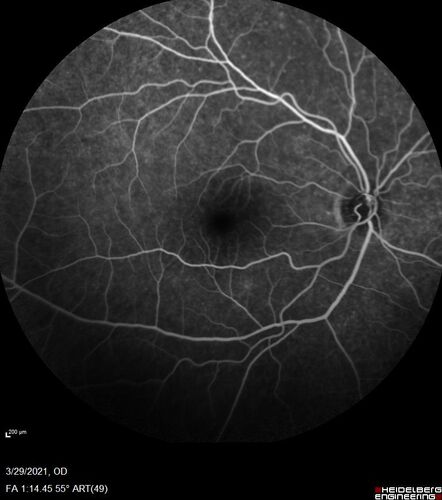 Ocular Lymphoma - Initially presented like auto-immune retinopathy
43 year old man: initial presentation - The vision in the left eye is blurry and opaque for about 2 weeks.Â  In the central of the vision, when he covers the right eye, in the center of the left eye there is a film with a light in the middle.Â  This has never happened before.Â  He has not been sick for the last few months.Â  A few weeks ago he saw waves on the floor when looking down but that has gone away.Â  Since the vision loss started the vision has not changed much.Â  The central vision is not getting better.Â Â 
PMHx â€“ Borderline HTN
VA OD: Dcc20/20
VA OS: Dcc20/40-1 IOP: TP: OD:15 OS:19
1+ NS 
No uveitis
Labs normal.  One positive antiretinal antibody - Arrestin
VA improved over 2 months to normal.  Then the patient had 2 more episodes of self-limited vision loss (no treatment).  Then 2 years later he presented with a diagnosis of CNS lymphoma and later developed subretinal deposits (last images)
