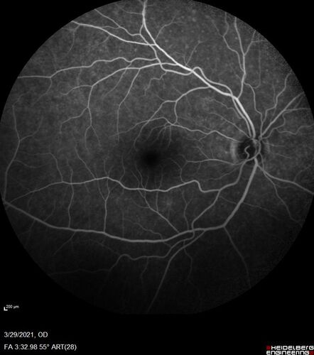 Ocular Lymphoma - Initially presented like auto-immune retinopathy
43 year old man: initial presentation - The vision in the left eye is blurry and opaque for about 2 weeks.Â  In the central of the vision, when he covers the right eye, in the center of the left eye there is a film with a light in the middle.Â  This has never happened before.Â  He has not been sick for the last few months.Â  A few weeks ago he saw waves on the floor when looking down but that has gone away.Â  Since the vision loss started the vision has not changed much.Â  The central vision is not getting better.Â Â 
PMHx â€“ Borderline HTN
VA OD: Dcc20/20
VA OS: Dcc20/40-1 IOP: TP: OD:15 OS:19
1+ NS 
No uveitis
Labs normal.  One positive antiretinal antibody - Arrestin
VA improved over 2 months to normal.  Then the patient had 2 more episodes of self-limited vision loss (no treatment).  Then 2 years later he presented with a diagnosis of CNS lymphoma and later developed subretinal deposits (last images)
