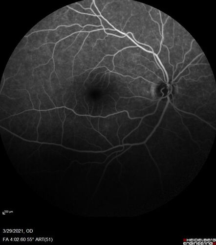 Ocular Lymphoma - Initially presented like auto-immune retinopathy
43 year old man: initial presentation - The vision in the left eye is blurry and opaque for about 2 weeks.Â  In the central of the vision, when he covers the right eye, in the center of the left eye there is a film with a light in the middle.Â  This has never happened before.Â  He has not been sick for the last few months.Â  A few weeks ago he saw waves on the floor when looking down but that has gone away.Â  Since the vision loss started the vision has not changed much.Â  The central vision is not getting better.Â Â 
PMHx â€“ Borderline HTN
VA OD: Dcc20/20
VA OS: Dcc20/40-1 IOP: TP: OD:15 OS:19
1+ NS 
No uveitis
Labs normal.  One positive antiretinal antibody - Arrestin
VA improved over 2 months to normal.  Then the patient had 2 more episodes of self-limited vision loss (no treatment).  Then 2 years later he presented with a diagnosis of CNS lymphoma and later developed subretinal deposits (last images)

