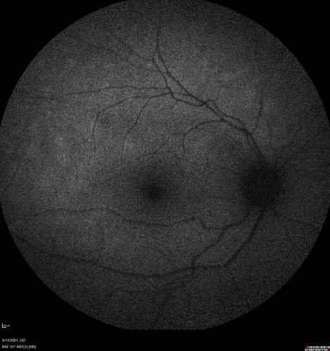 Ocular Lymphoma - Initially presented like auto-immune retinopathy
43 year old man: initial presentation - The vision in the left eye is blurry and opaque for about 2 weeks.Â  In the central of the vision, when he covers the right eye, in the center of the left eye there is a film with a light in the middle.Â  This has never happened before.Â  He has not been sick for the last few months.Â  A few weeks ago he saw waves on the floor when looking down but that has gone away.Â  Since the vision loss started the vision has not changed much.Â  The central vision is not getting better.Â Â 
PMHx â€“ Borderline HTN
VA OD: Dcc20/20
VA OS: Dcc20/40-1 IOP: TP: OD:15 OS:19
1+ NS 
No uveitis
Labs normal.  One positive antiretinal antibody - Arrestin
VA improved over 2 months to normal.  Then the patient had 2 more episodes of self-limited vision loss (no treatment).  Then 2 years later he presented with a diagnosis of CNS lymphoma and later developed subretinal deposits (last images)
