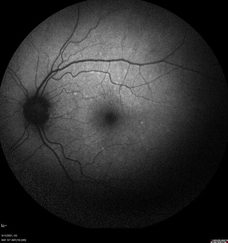 Ocular Lymphoma - Initially presented like auto-immune retinopathy
43 year old man: initial presentation - The vision in the left eye is blurry and opaque for about 2 weeks.Â  In the central of the vision, when he covers the right eye, in the center of the left eye there is a film with a light in the middle.Â  This has never happened before.Â  He has not been sick for the last few months.Â  A few weeks ago he saw waves on the floor when looking down but that has gone away.Â  Since the vision loss started the vision has not changed much.Â  The central vision is not getting better.Â Â 
PMHx â€“ Borderline HTN
VA OD: Dcc20/20
VA OS: Dcc20/40-1 IOP: TP: OD:15 OS:19
1+ NS 
No uveitis
Labs normal.  One positive antiretinal antibody - Arrestin
VA improved over 2 months to normal.  Then the patient had 2 more episodes of self-limited vision loss (no treatment).  Then 2 years later he presented with a diagnosis of CNS lymphoma and later developed subretinal deposits (last images)
