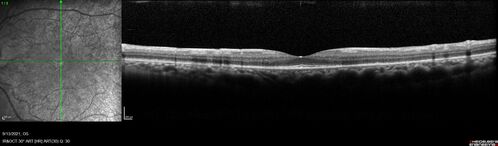 Ocular Lymphoma - Initially presented like auto-immune retinopathy
43 year old man: initial presentation - The vision in the left eye is blurry and opaque for about 2 weeks.Â  In the central of the vision, when he covers the right eye, in the center of the left eye there is a film with a light in the middle.Â  This has never happened before.Â  He has not been sick for the last few months.Â  A few weeks ago he saw waves on the floor when looking down but that has gone away.Â  Since the vision loss started the vision has not changed much.Â  The central vision is not getting better.Â Â 
PMHx â€“ Borderline HTN
VA OD: Dcc20/20
VA OS: Dcc20/40-1 IOP: TP: OD:15 OS:19
1+ NS 
No uveitis
Labs normal.  One positive antiretinal antibody - Arrestin
VA improved over 2 months to normal.  Then the patient had 2 more episodes of self-limited vision loss (no treatment).  Then 2 years later he presented with a diagnosis of CNS lymphoma and later developed subretinal deposits (last images)
