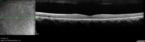 Ocular Lymphoma - Initially presented like auto-immune retinopathy
43 year old man: initial presentation - The vision in the left eye is blurry and opaque for about 2 weeks.Â  In the central of the vision, when he covers the right eye, in the center of the left eye there is a film with a light in the middle.Â  This has never happened before.Â  He has not been sick for the last few months.Â  A few weeks ago he saw waves on the floor when looking down but that has gone away.Â  Since the vision loss started the vision has not changed much.Â  The central vision is not getting better.Â Â 
PMHx â€“ Borderline HTN
VA OD: Dcc20/20
VA OS: Dcc20/40-1 IOP: TP: OD:15 OS:19
1+ NS 
No uveitis
Labs normal.  One positive antiretinal antibody - Arrestin
VA improved over 2 months to normal.  Then the patient had 2 more episodes of self-limited vision loss (no treatment).  Then 2 years later he presented with a diagnosis of CNS lymphoma and later developed subretinal deposits (last images)
